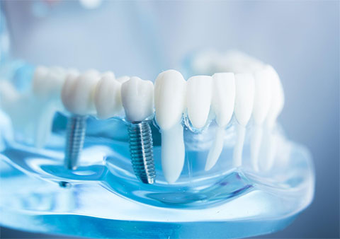 Full Mouth Dental Implants | East Bentleigh Dental Group